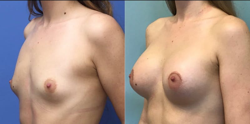 Breast Augmentation Before & After Gallery - Patient 376792 - Image 1