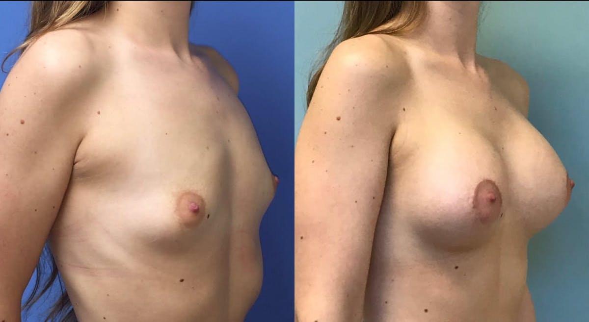 Breast Augmentation Before & After Gallery - Patient 376792 - Image 2