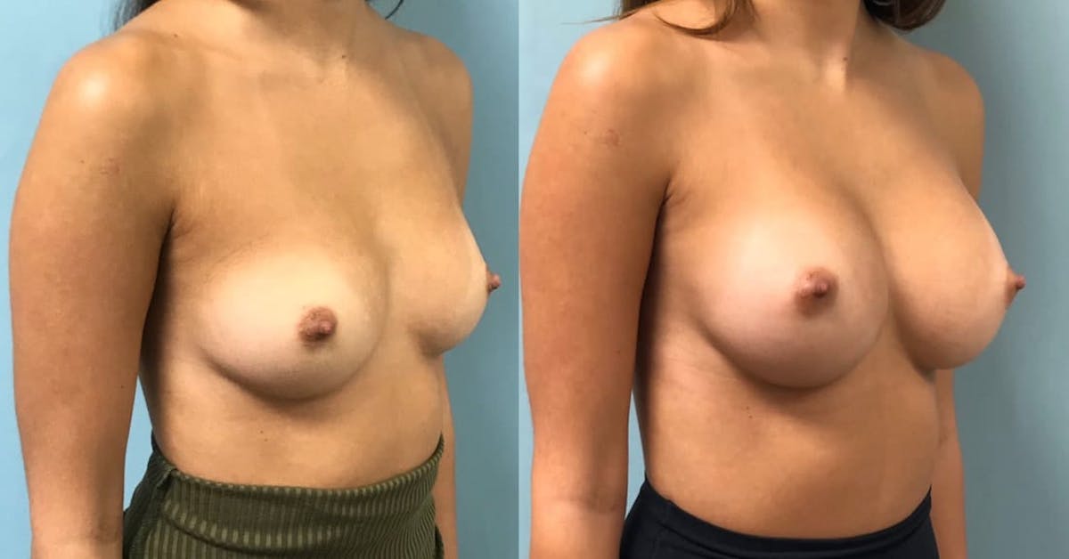 Breast Augmentation Before & After Gallery - Patient 294639 - Image 2