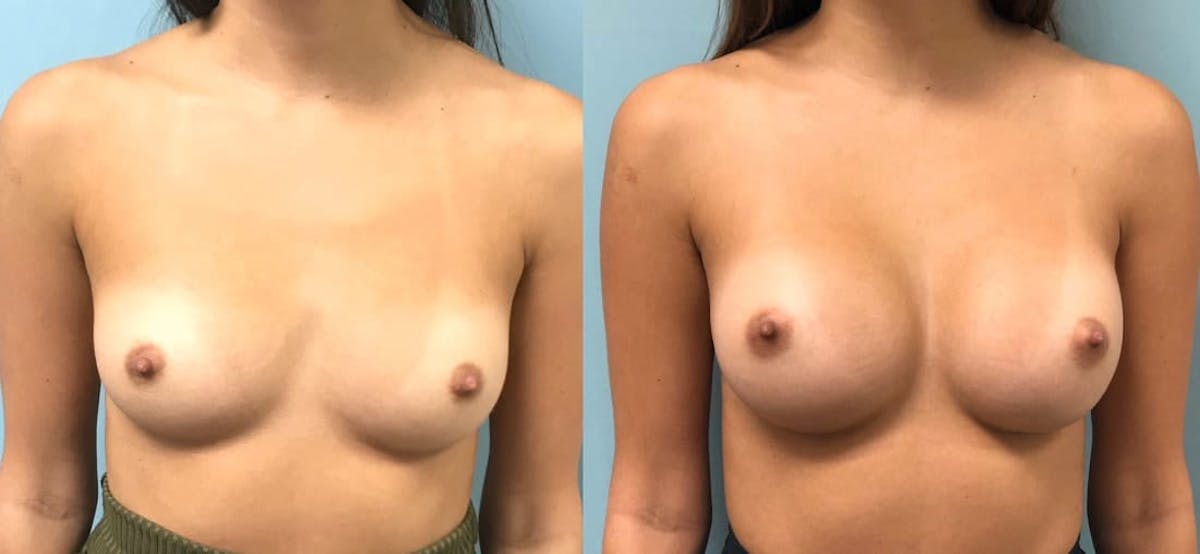 Breast Augmentation Before & After Gallery - Patient 294639 - Image 3