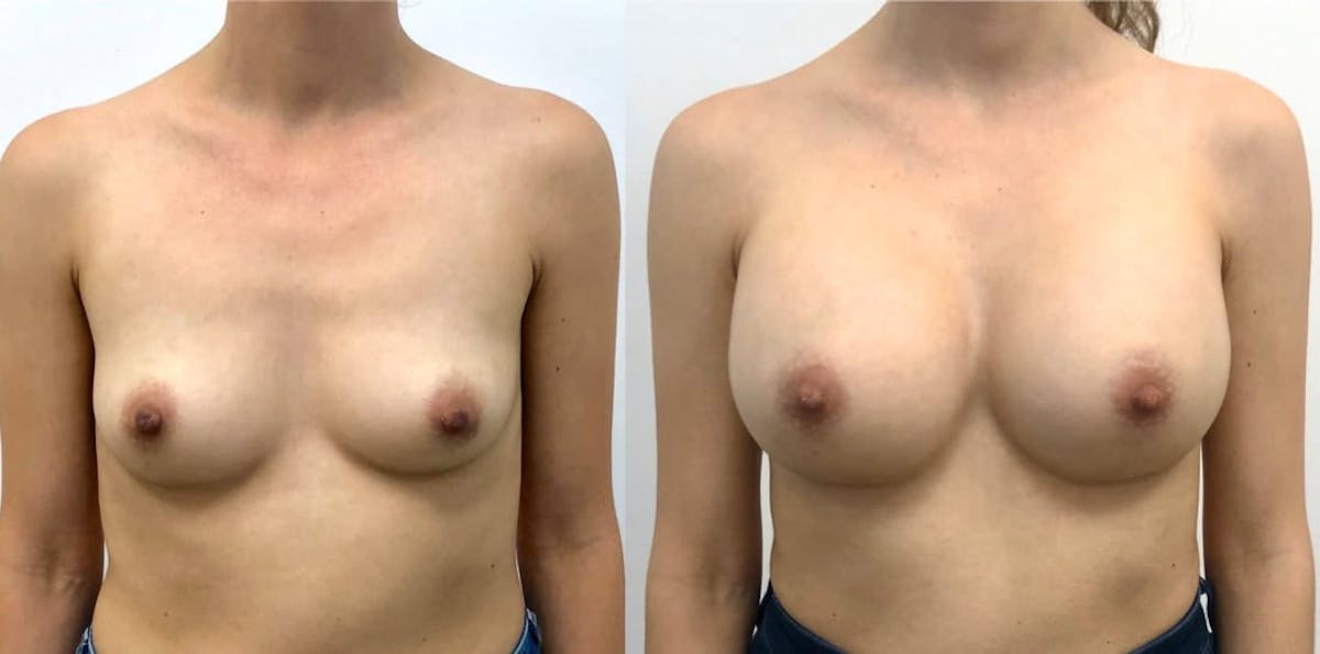 Breast Augmentation Before & After Gallery - Patient 105697 - Image 1