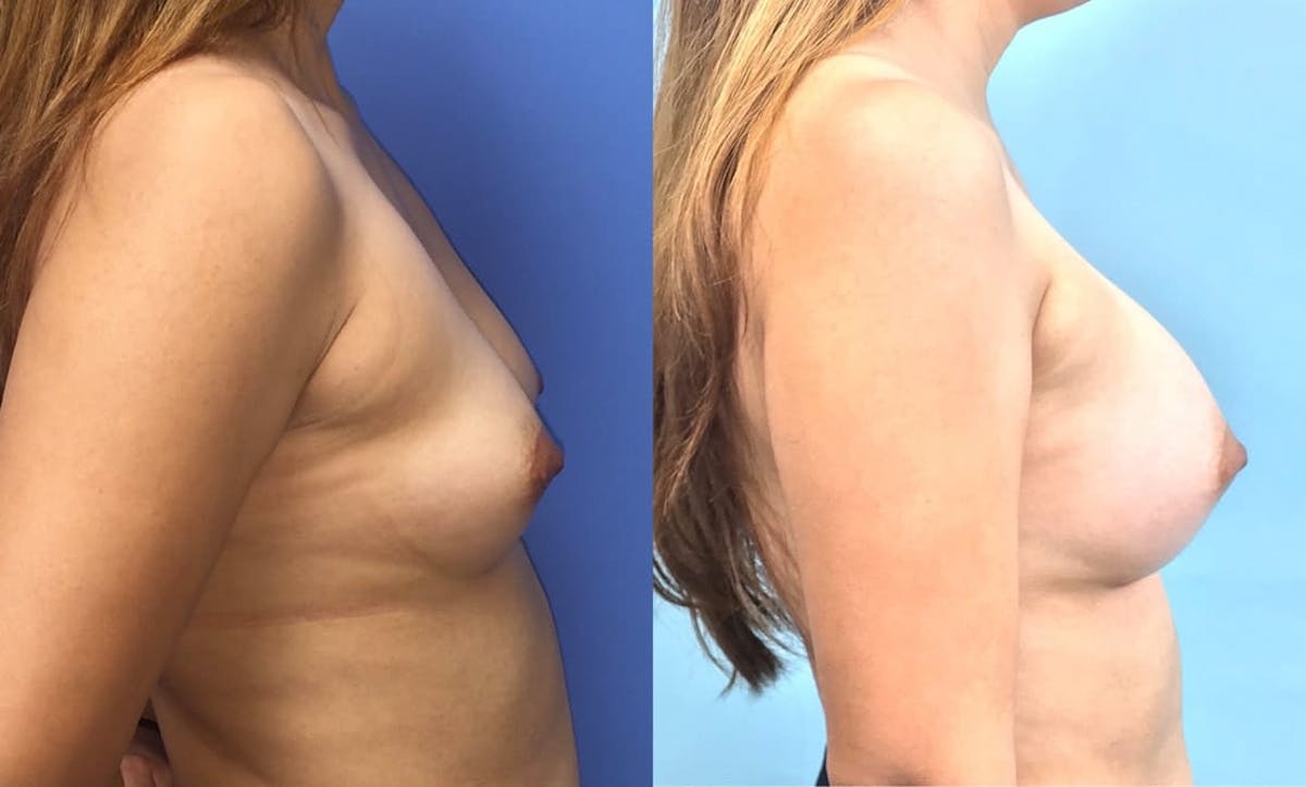 Breast Augmentation Before & After Gallery - Patient 233584 - Image 1