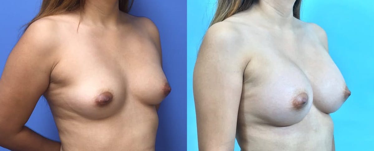 Breast Augmentation Before & After Gallery - Patient 233584 - Image 2