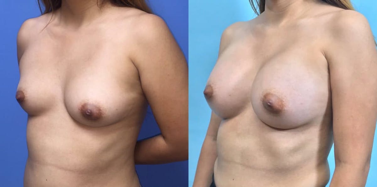 Breast Augmentation Before & After Gallery - Patient 233584 - Image 3