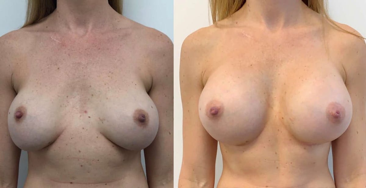 Breast Augmentation Before & After Gallery - Patient 146772 - Image 1