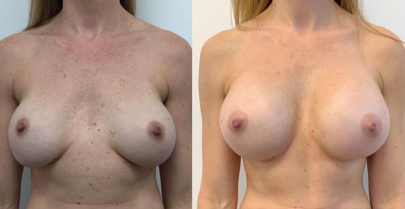 Breast Augmentation Before & After Gallery - Patient 146772 - Image 1