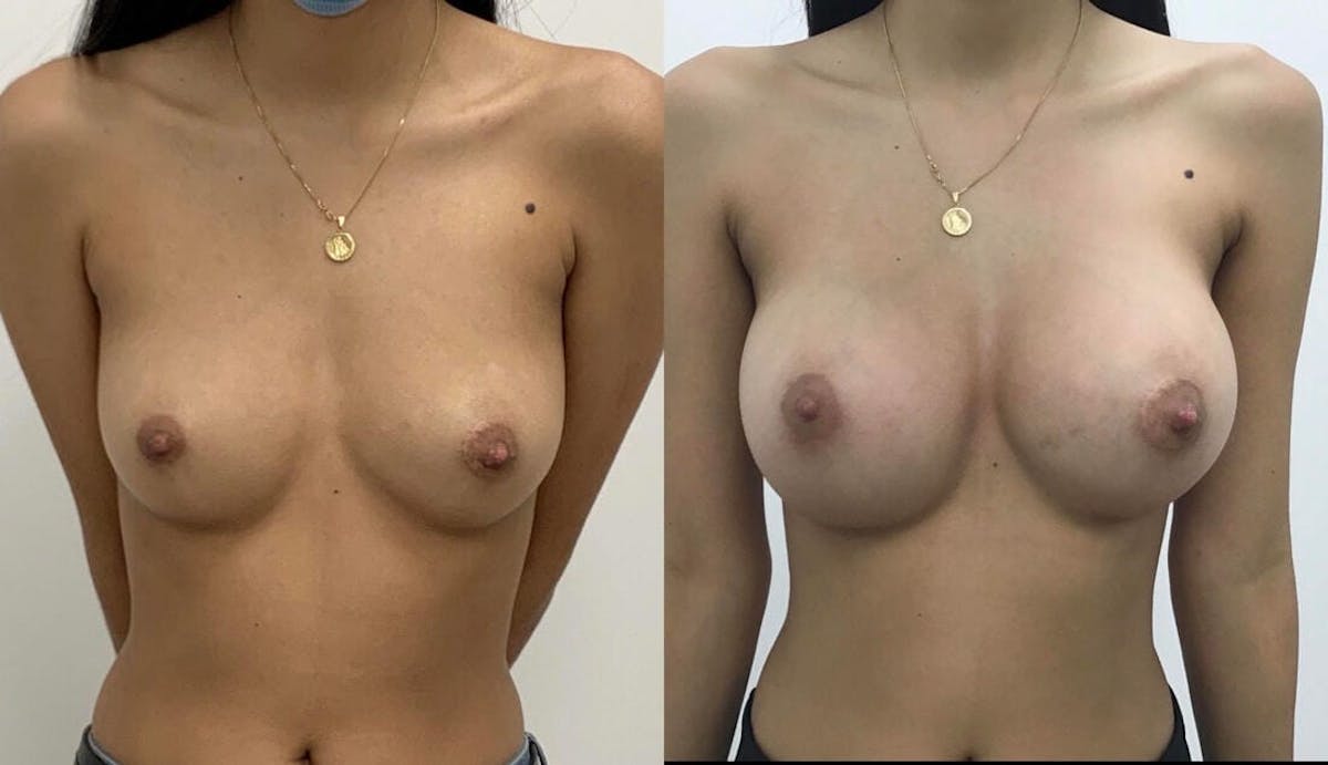 Breast Augmentation Before & After Gallery - Patient 421909 - Image 1