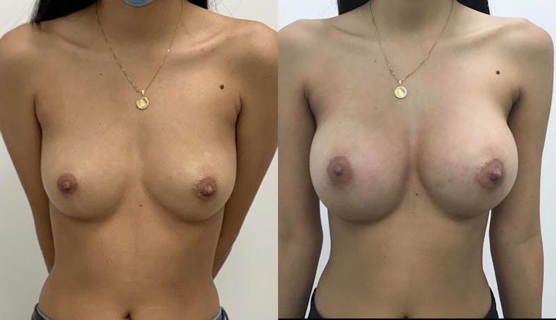 Breast Augmentation Before & After Gallery - Patient 421909 - Image 1