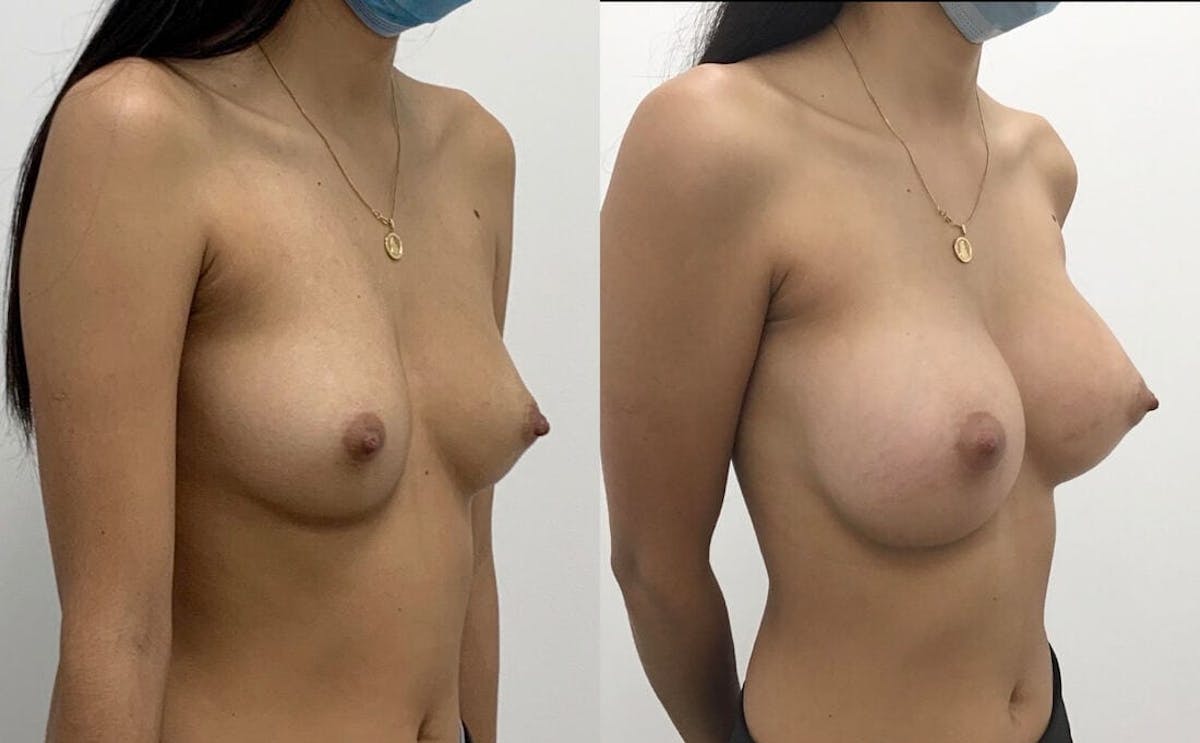 Breast Augmentation Before & After Gallery - Patient 421909 - Image 2