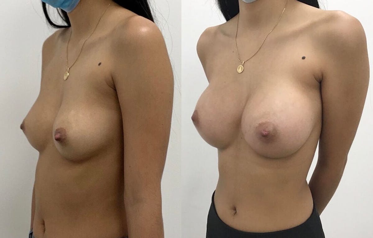 Breast Augmentation Before & After Gallery - Patient 421909 - Image 3
