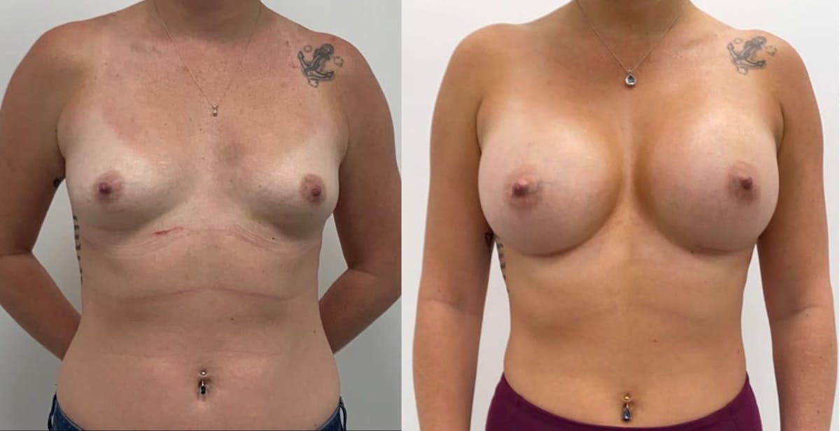 Breast Augmentation Before & After Gallery - Patient 151770 - Image 1