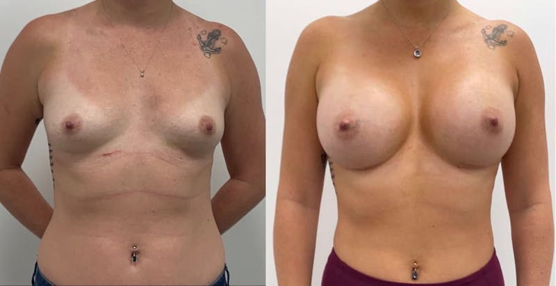 Breast Augmentation Before & After Gallery - Patient 151770 - Image 1