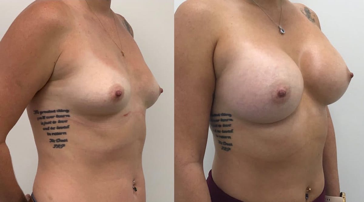 Breast Augmentation Before & After Gallery - Patient 151770 - Image 2
