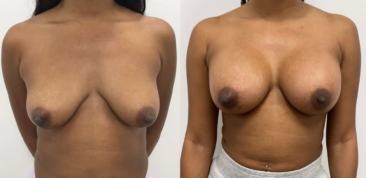 Breast Augmentation Before & After Gallery - Patient 185480 - Image 1