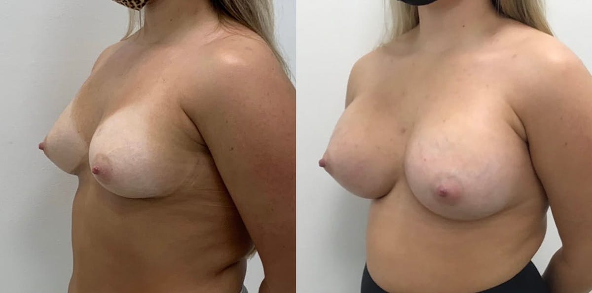 Breast Augmentation Before & After Gallery - Patient 450922 - Image 1