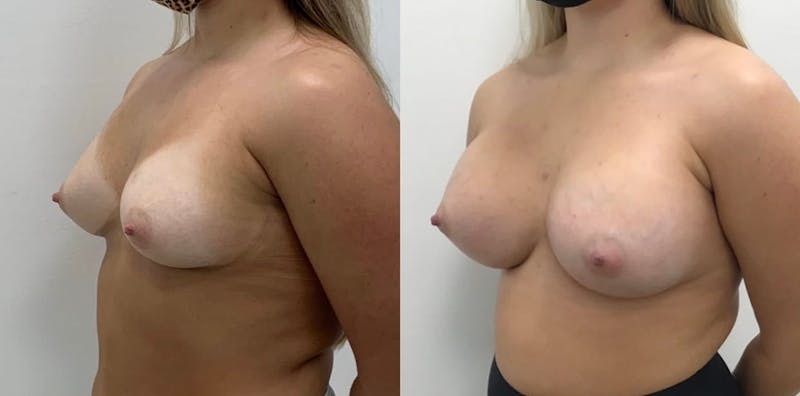 Breast Augmentation Before & After Gallery - Patient 450922 - Image 1