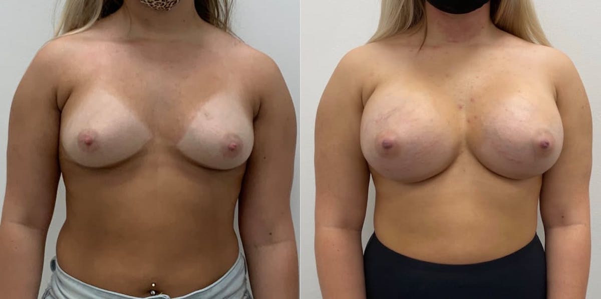 Breast Augmentation Before & After Gallery - Patient 450922 - Image 2