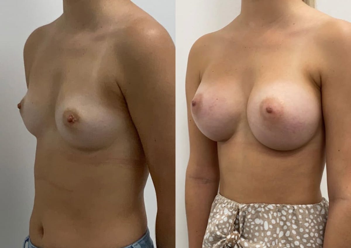 Breast Augmentation Before & After Gallery - Patient 259697 - Image 1