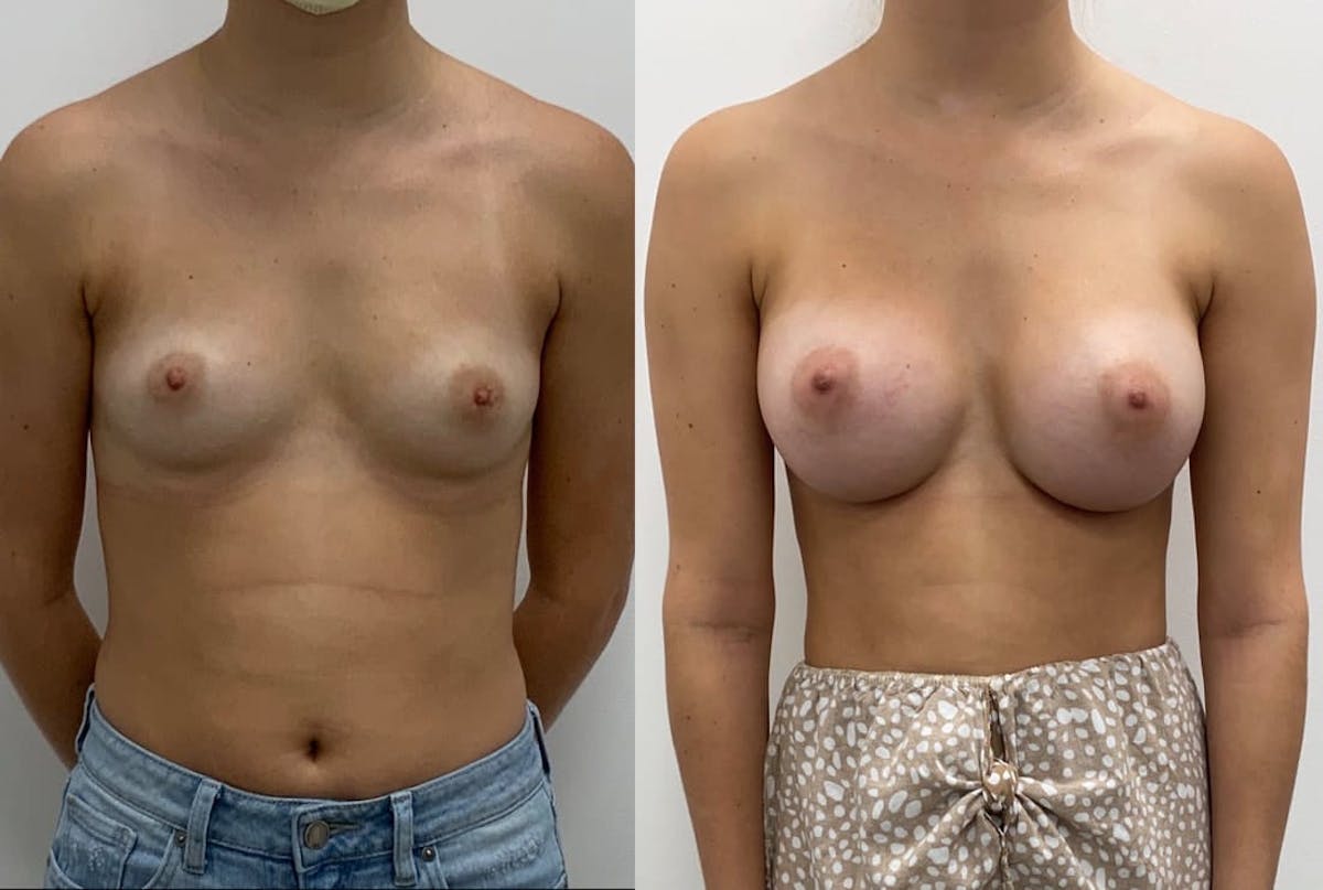 Breast Augmentation Before & After Gallery - Patient 259697 - Image 2