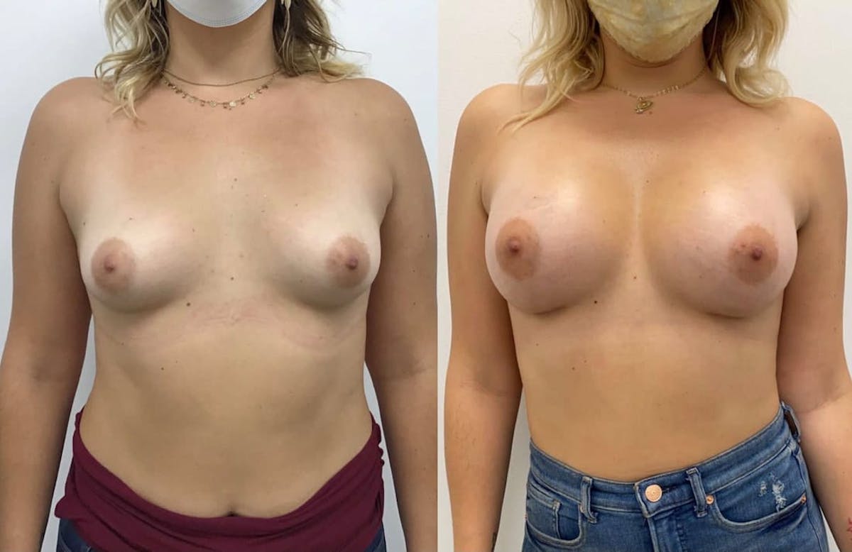 Breast Augmentation Before & After Gallery - Patient 399106 - Image 2