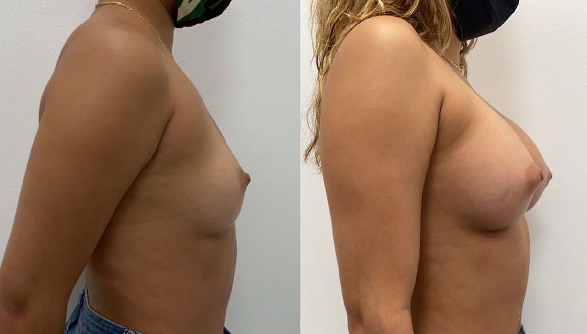 Breast Augmentation Before & After Gallery - Patient 358348 - Image 1