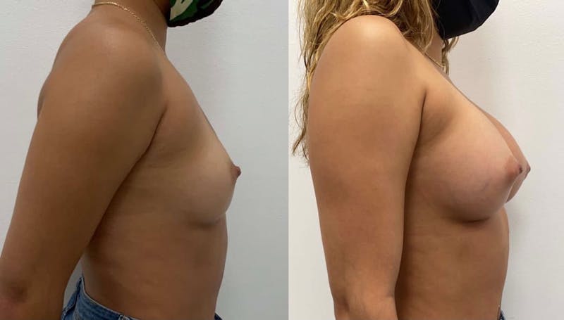 Breast Augmentation Before & After Gallery - Patient 358348 - Image 1