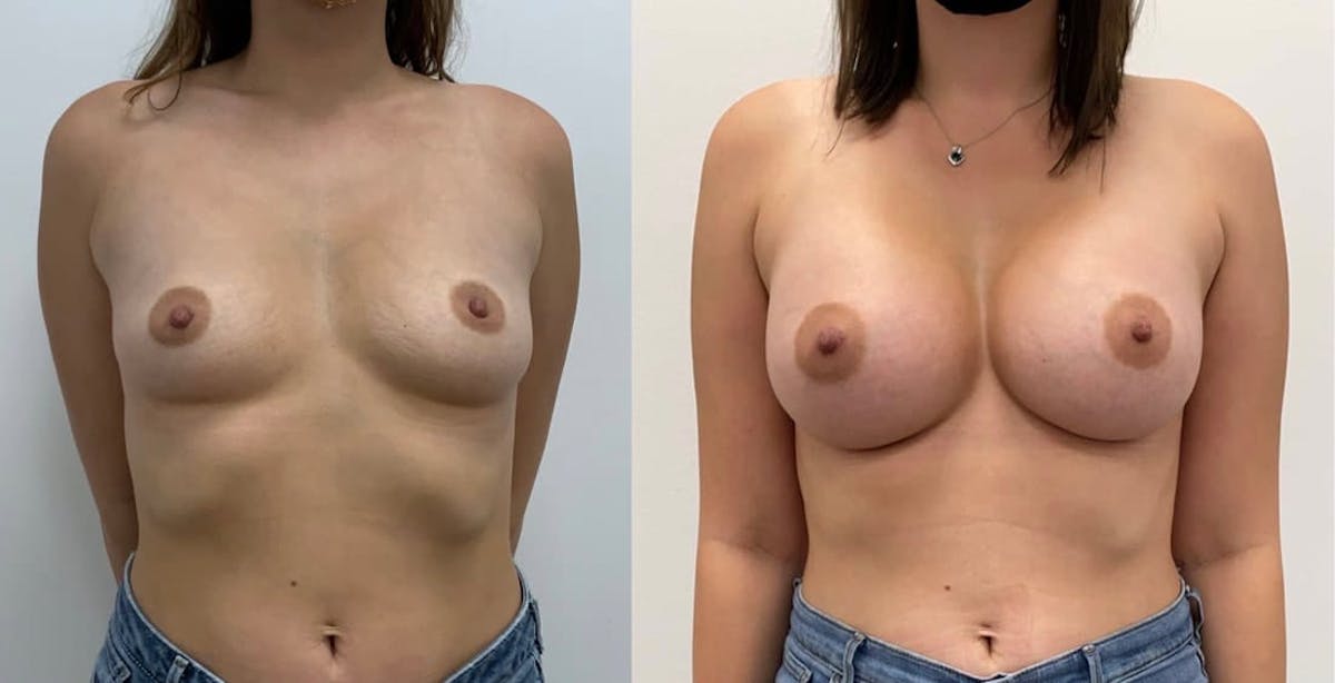 Breast Augmentation Before & After Gallery - Patient 176312 - Image 1