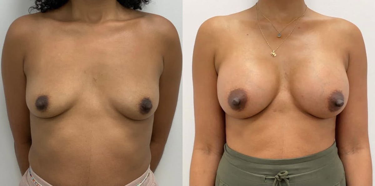 Breast Augmentation Before & After Gallery - Patient 185499 - Image 1