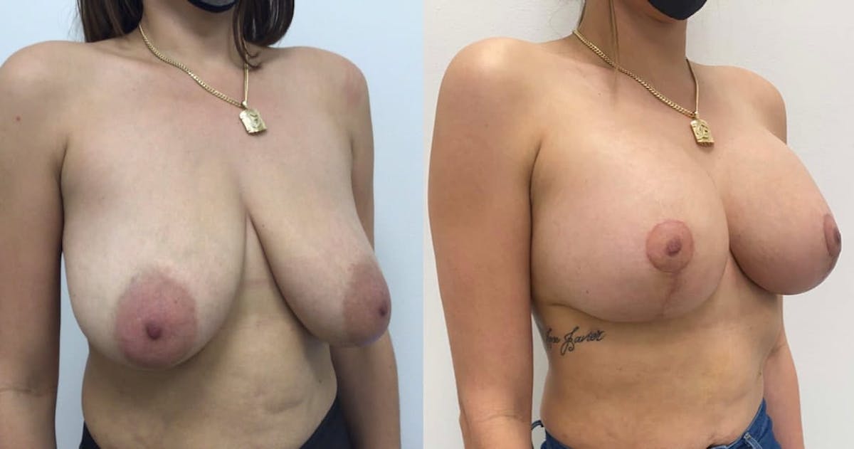 Breast Augmentation Before & After Gallery - Patient 264035 - Image 1