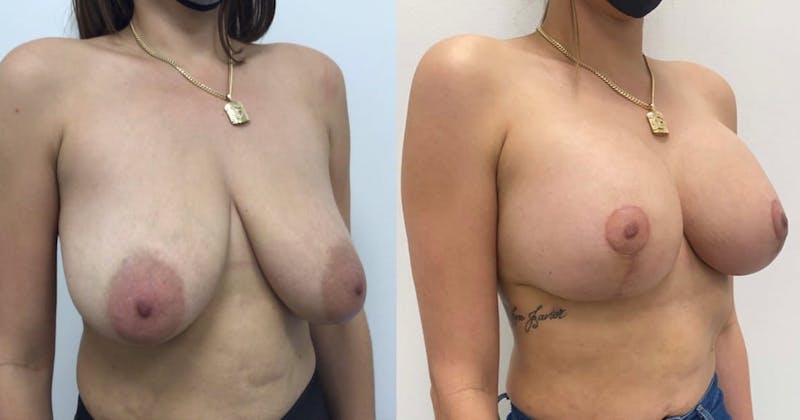 Breast Augmentation Before & After Gallery - Patient 264035 - Image 1