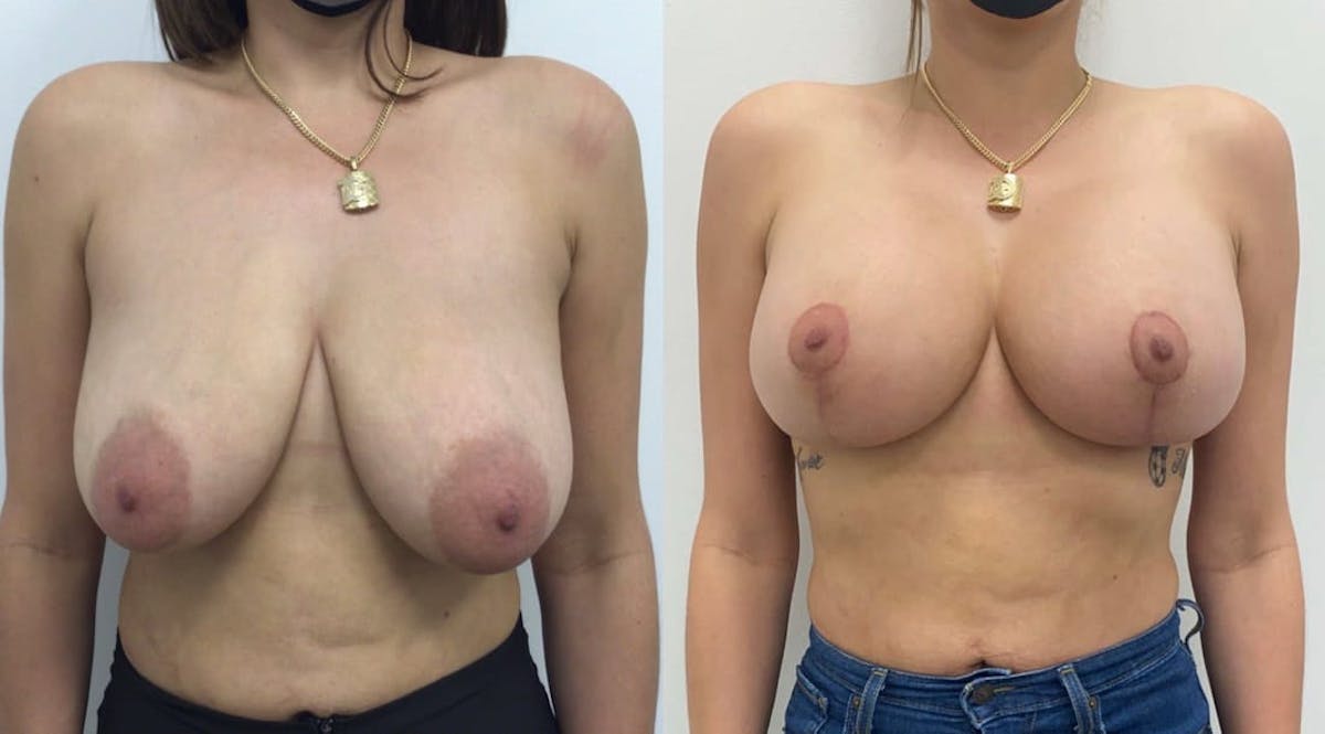 Breast Augmentation Before & After Gallery - Patient 264035 - Image 2