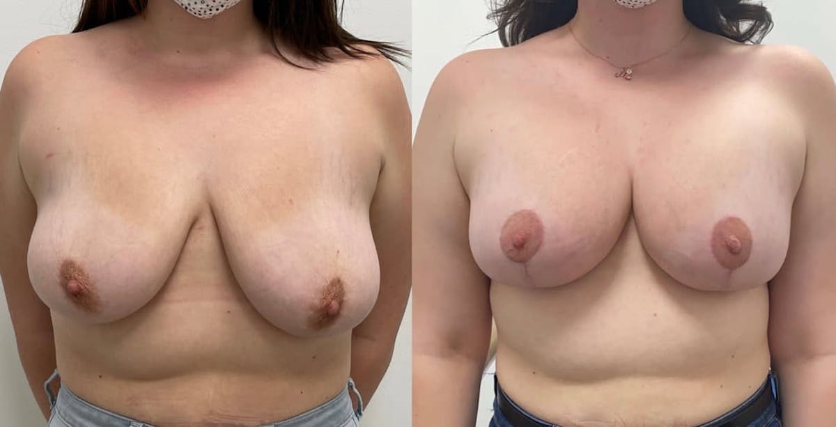 Breast Augmentation Before & After Gallery - Patient 264035 - Image 3