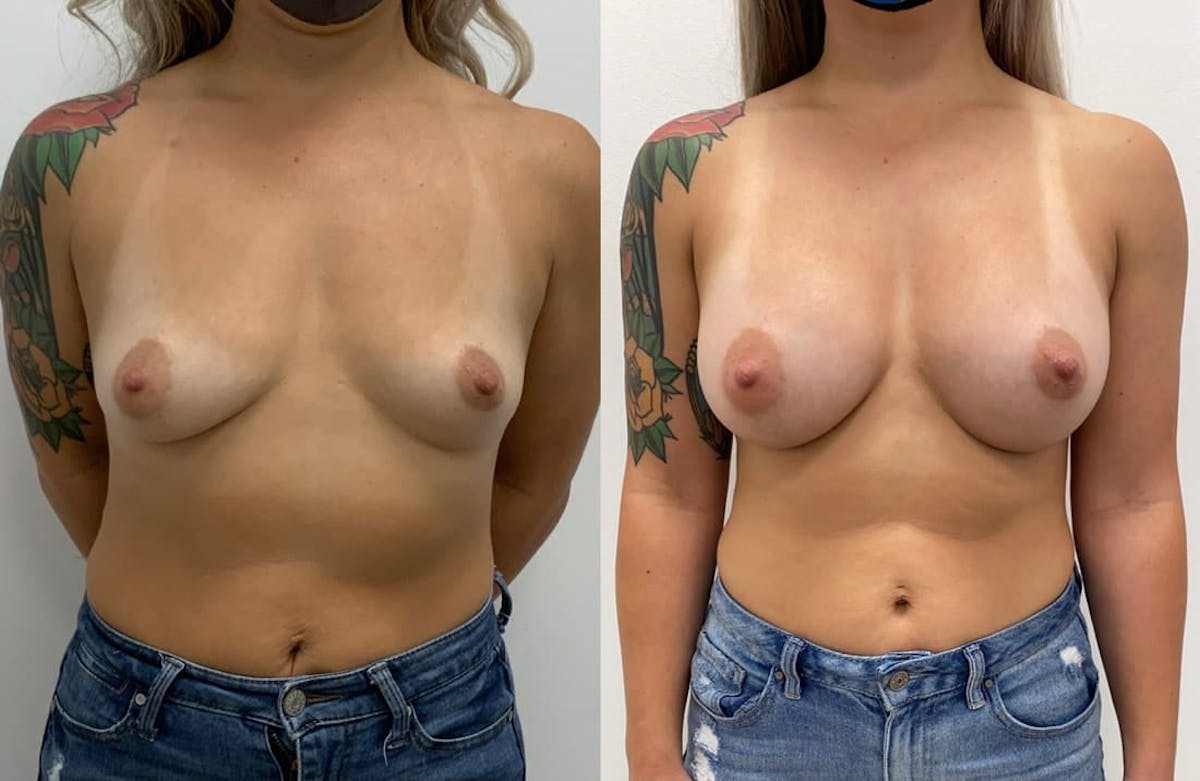 Breast Augmentation Before & After Gallery - Patient 267929 - Image 1