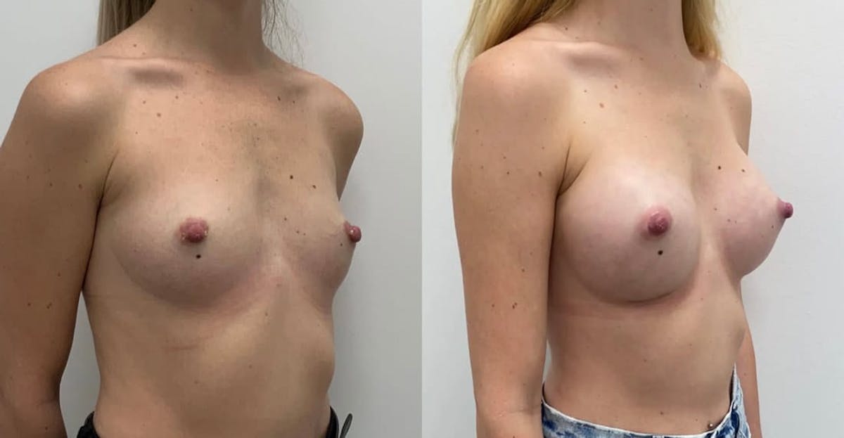 Breast Augmentation Before & After Gallery - Patient 232657 - Image 1