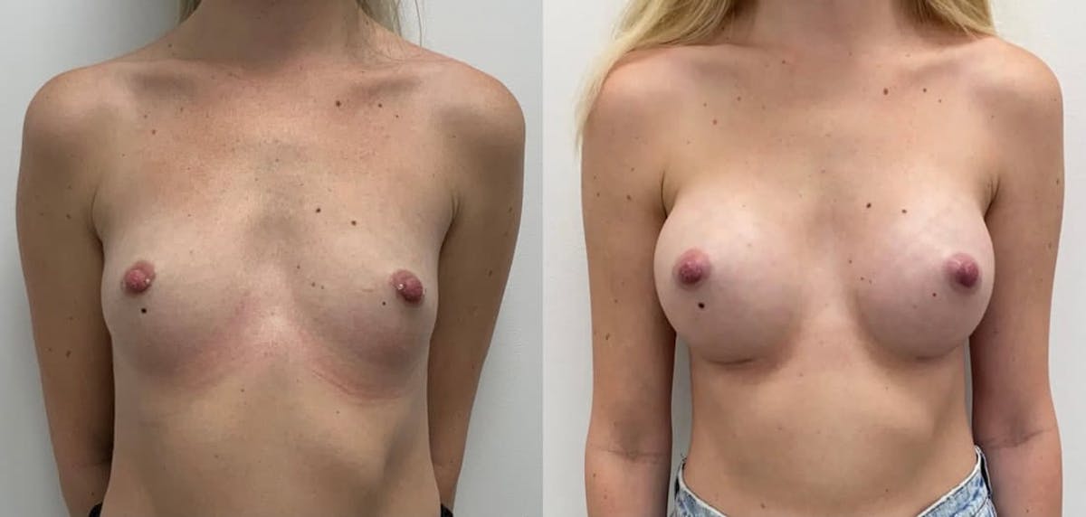 Breast Augmentation Before & After Gallery - Patient 232657 - Image 2