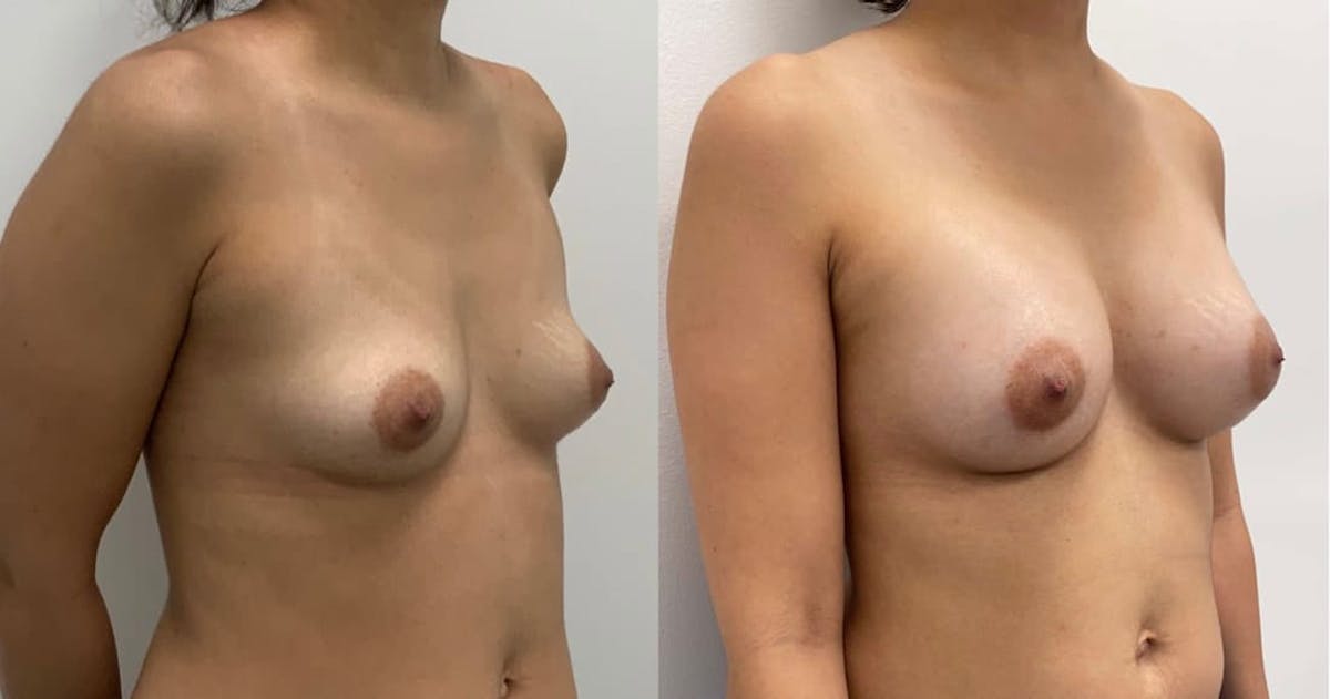 Breast Augmentation Before & After Gallery - Patient 293664 - Image 1