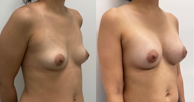 Breast Augmentation Before & After Gallery - Patient 293664 - Image 1