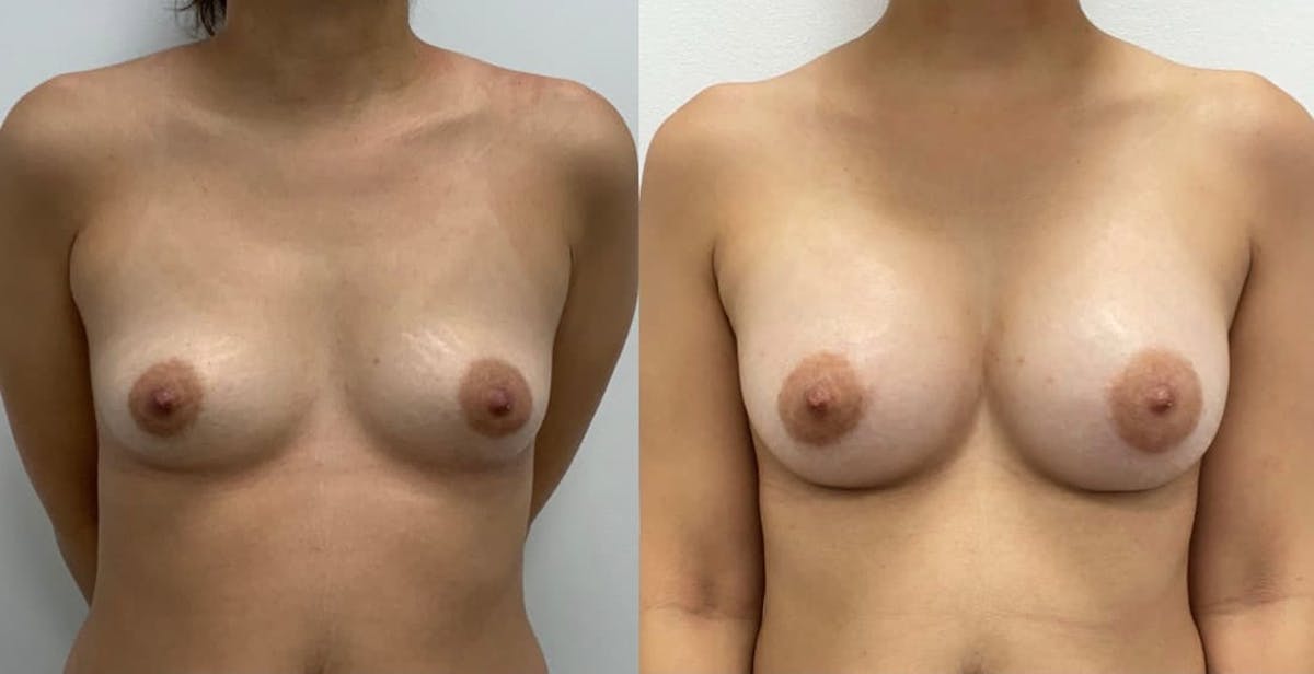 Breast Augmentation Before & After Gallery - Patient 293664 - Image 2