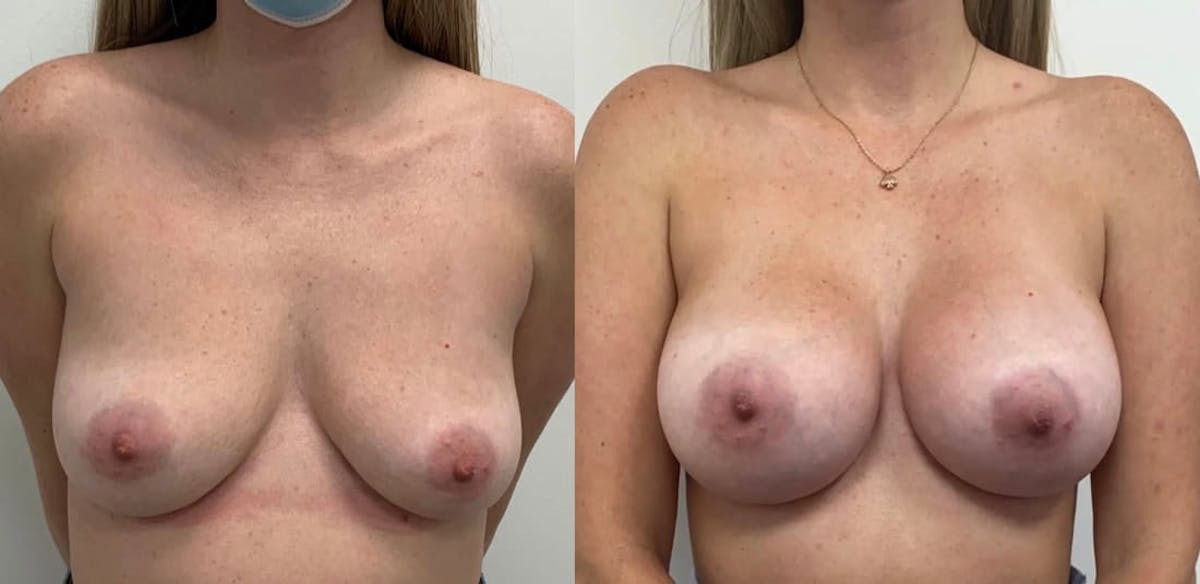 Breast Augmentation Before & After Gallery - Patient 252606 - Image 2