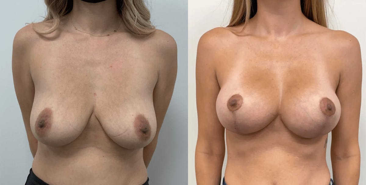 Breast Augmentation Before & After Gallery - Patient 374547 - Image 1