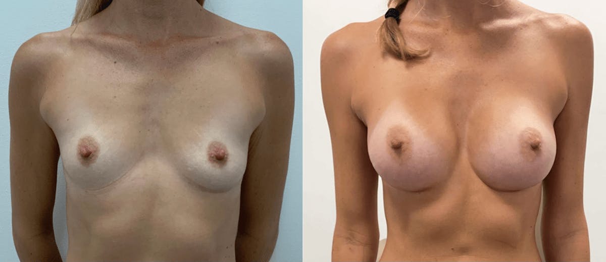 Breast Augmentation Before & After Gallery - Patient 728672 - Image 1