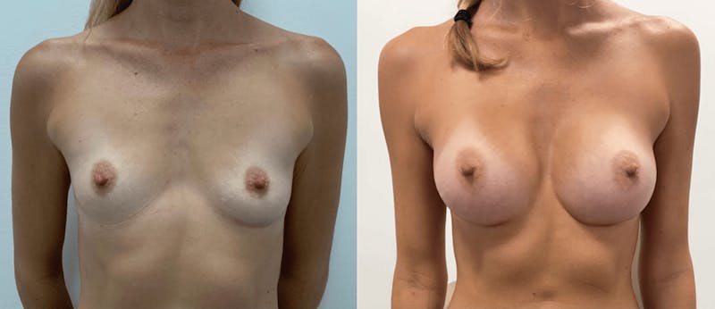 Breast Augmentation Before & After Gallery - Patient 728672 - Image 1