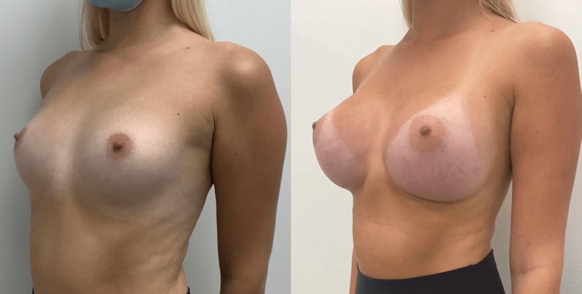 Breast Augmentation Before & After Gallery - Patient 728672 - Image 2