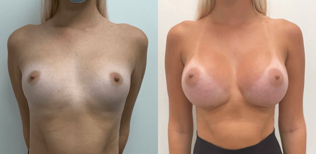 Breast Augmentation Before & After Gallery - Patient 728672 - Image 3