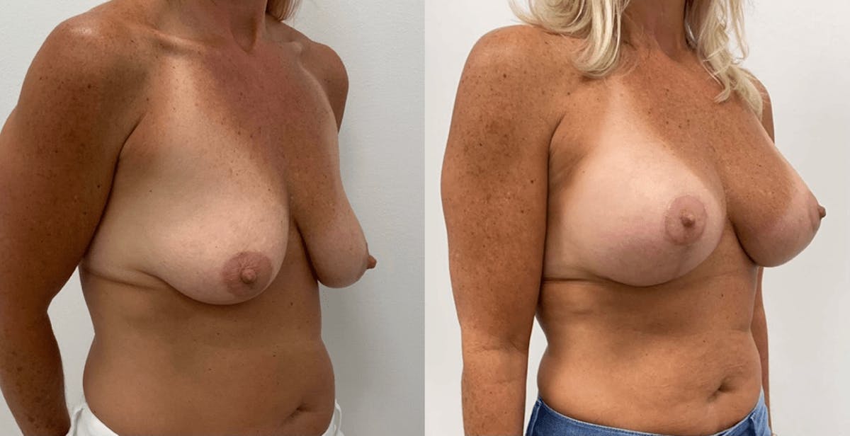 Breast Augmentation Before & After Gallery - Patient 347683 - Image 1