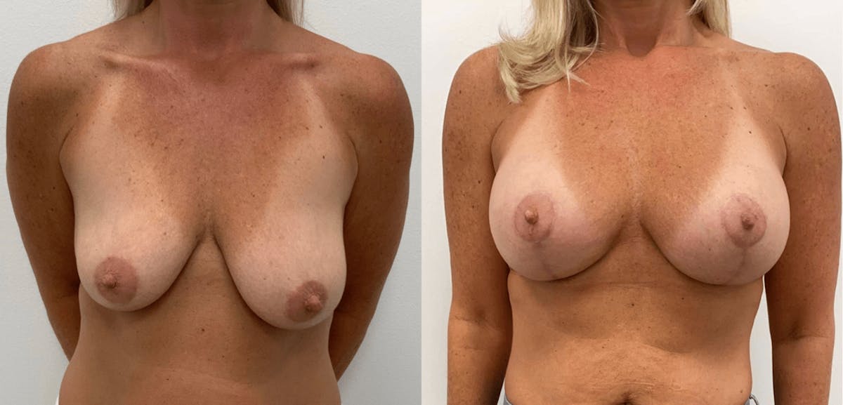 Breast Augmentation Before & After Gallery - Patient 347683 - Image 2