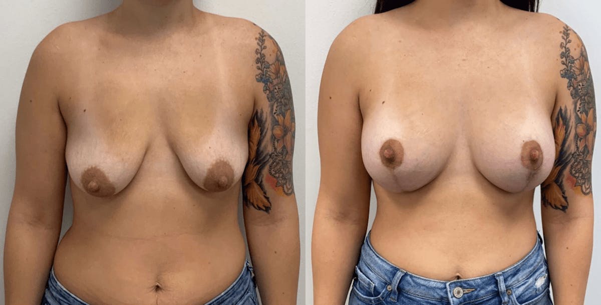 Breast Augmentation Before & After Gallery - Patient 428708 - Image 1