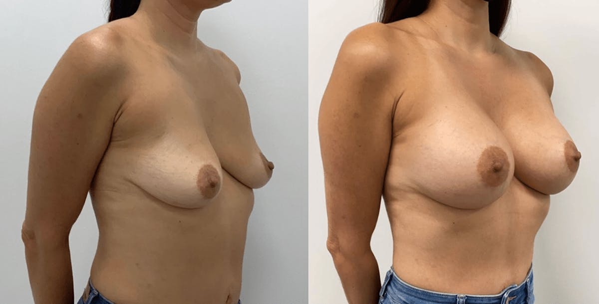 Breast Augmentation Before & After Gallery - Patient 160428 - Image 1
