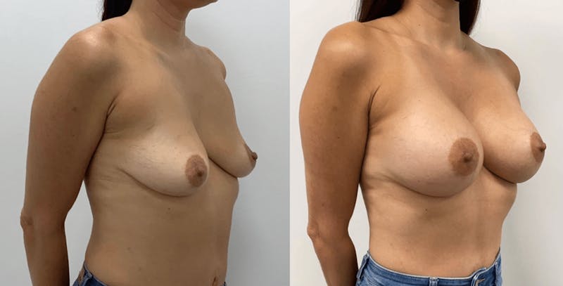 Breast Augmentation Before & After Gallery - Patient 160428 - Image 1