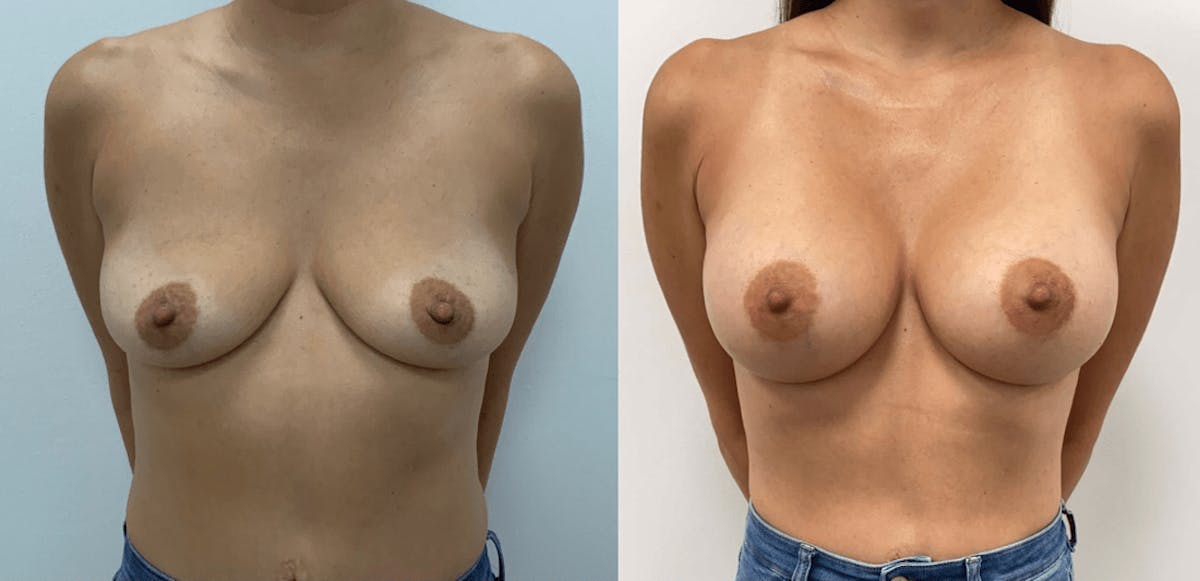 Breast Augmentation Before & After Gallery - Patient 160428 - Image 2